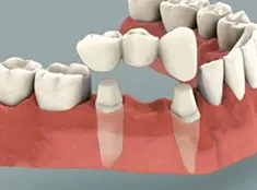Dental Bridges thumbnail