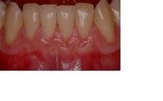 Gum Grafting Dentist in Scottsdale, AZ | Zuch Periodontics & Dental Implants
