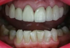 woman's teeth after smile makeover with partial denture and teeth whitening Cumberland Park, SA dentist