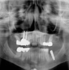 Sinus Lift X-Ray