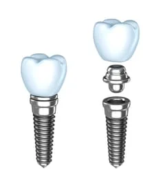 Dental Implants | Dentist in Columbia, SC | Smith Family Dentistry