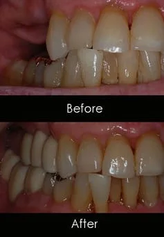 image of teeth before and after dental implants Royal Palm Beach, FL