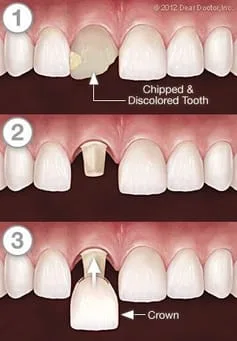 Independence, MO dental crowns process