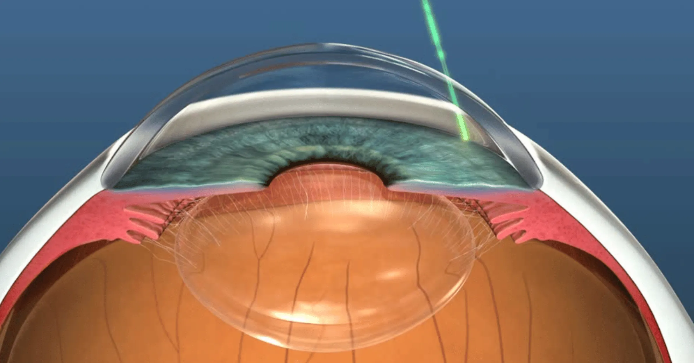 glaucoma-treatment-evaluation-exam-slt-phoenix-scottsdale-chandler-tempe