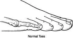 Normal toes, unaffected by hammertoe