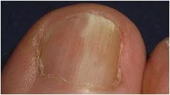 Fungal Nail Laser Treatments - Sheldon H. Nadal, D.P.M.