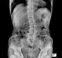 scoliosis x-ray