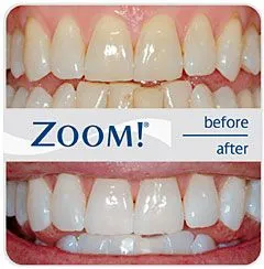 before and after results of professional teeth whitening with Zoom! Whitening, cosmetic dentistry Lawrenceville, GA dentist 