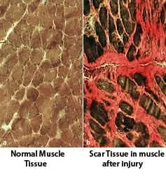 muscle_scar_tissue.jpg