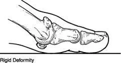 Rigid deformity of the big toe caused by Hallux Rigidus