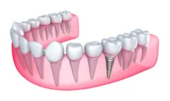 model of teeth and gums showing dental implants next to natural teeth. dental implants, Ocala, FL