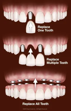 Dental Implants San Antonio, TX and Shavano Park