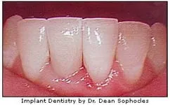 Implant dentistry by Dr. Dean Sophocles