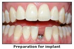 Preparation for implant