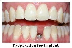 Preparation for implant
