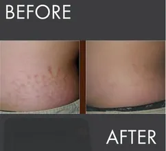 Stretch-mark fading results