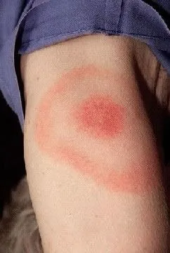 <strong>
</picture>Erythema Migrans Rash</strong> <p>Most cases of Lyme disease start with a bull's eye rash at the site of the tick bite. The rash can occur from days to weeks (typically 7-10 days) after a tick bite. </p><p>If this rash appears, treatment with antibiotics is recommended. </p><p>It is thought that Lyme Disease can be prevented if the tick is removed within 24 hours of attachment.</p>