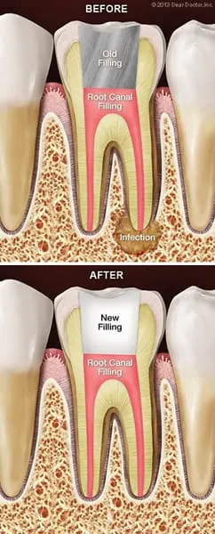 Root canal retreatment | Dentist In Waterford, MI | Crescent Lake Dental