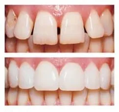 before and after image of teeth with porcelain veneers Mahwah, NJ
