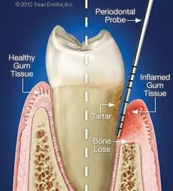 illustration of tooth, half showing healthy tooth and gums, half with periodontitis Albuquerque, NM gum disease