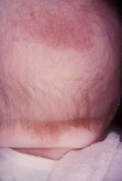 <strong>
</picture>Stork Bite of Neck and Posterior Scalp</strong> <p>This shows a storkbite which is a birthmark often found in babies.  These birthmarks usually go away on their own.</p><p>Some brief notes about storkbites: </p><ul><li>Flat pink birthmark</li><li>Present in 50% of newborns</li><li>Also called salmon patches</li><li>Most fade by 3 years, but 25% are still present into adulthood</li></ul>