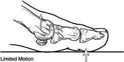 Limited motion of the big toe caused by hallux rigidus