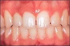 dental implants 4