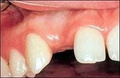 Dental_Implants_1.jpg