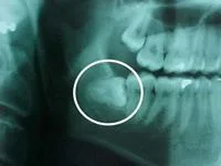 xray image showing impacted wisdom tooth, needs wisdom tooth extraction Mahwah, NJ