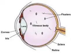 vitreous floaters