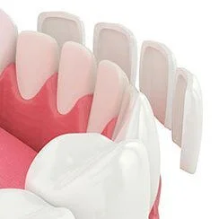 3D illustration of lower arch of teeth and gums, dental veneers being placed over front of teeth, veneers Boca Raton, FL dentist