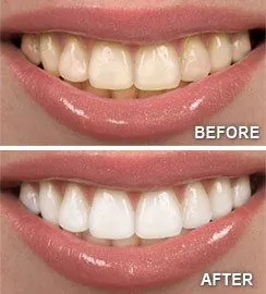 Whitening