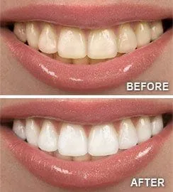 Teeth Whitening Menlo Park CA | Dentist Redwood City CA