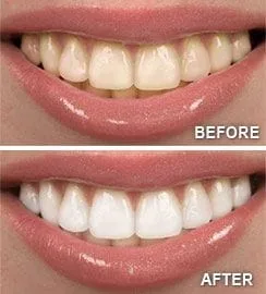 before and after image of mouth after professional teeth whitening Fond du Lac, WI