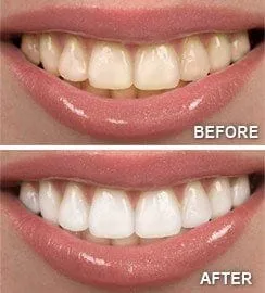Teeth Whitening | Dentist In Columbia, SC | O'Neill Family Dentistry