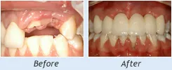 Before and After Dental Implants Bolingbrook, IL