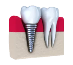 Dental Implants Stamford