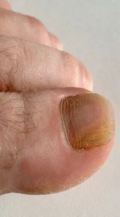 Philadelphia Podiatrist | Philadelphia Onychomycosis | PA | Frankford Podiatry Associates, P.C. |