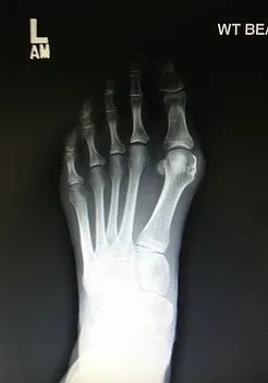 Lapidus bunion correction with large screw.