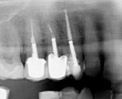 Root_Canal