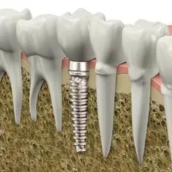 Dental Implants | Dentist In Freemont, Auburn and Angola, IN
