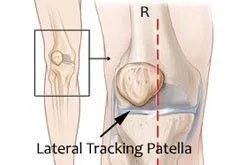 Patella Tracking Disorder Causes and Solutions