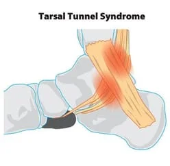 Tarsal_tunnell_syndrome.jpg