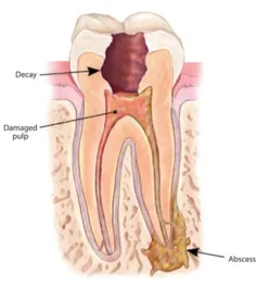 Tooth Needing Root Canal
