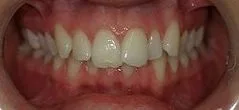 White braces rapidly straightening teeth without Invisalign