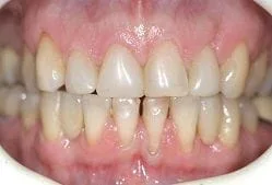 Porcelain Teeth to replace gaps in Adelaide