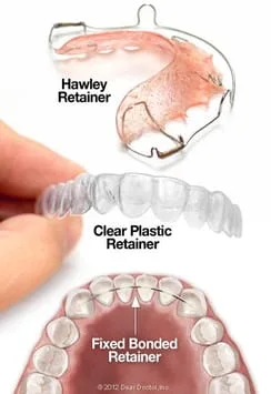 Types of Orthodontic Retainers