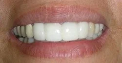 dental_implant5.png