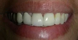 dental_implant5.png