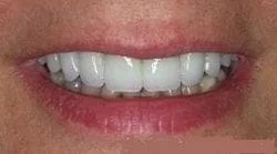 Fractured Teeth After - Dentist in Huntsville, AL